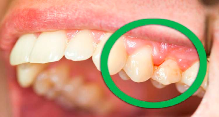 A boca seca é outro fator de risco para as danadas aparecerem – Foto: Reprodução