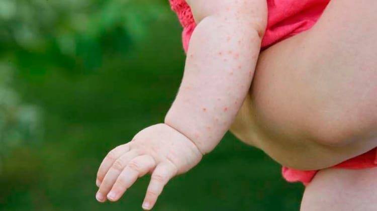 Os sintomas do sarampo, doença que pode matar e voltou a assustar no Brasil