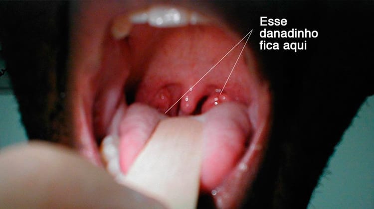 Você sabe o que são aquelas bolinhas fedidas que aparecem na garganta?