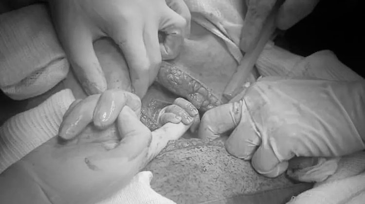 Ao abrir barriga em cesárea, bebê segura dedo de médica e emociona equipe e família