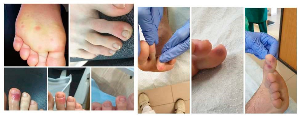 Lesões nos pés são encontrada em pacientes com covid-19