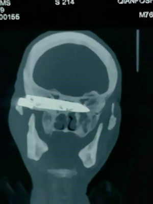 Médicos retiram faca alojada na cabeça de um homem há 26 anos