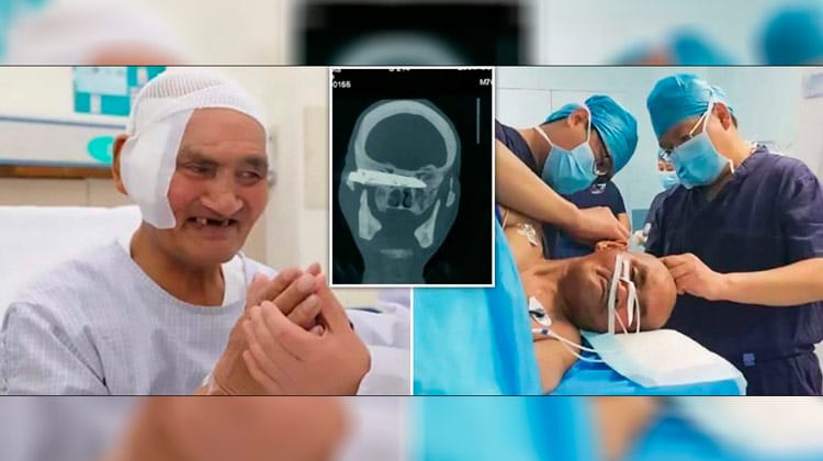 Médicos retiram faca alojada na cabeça de um homem há 26 anos