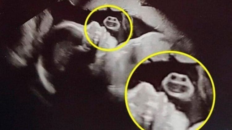 'Tartaruga Ninja?': figura no ultrassom choca mãe e viraliza