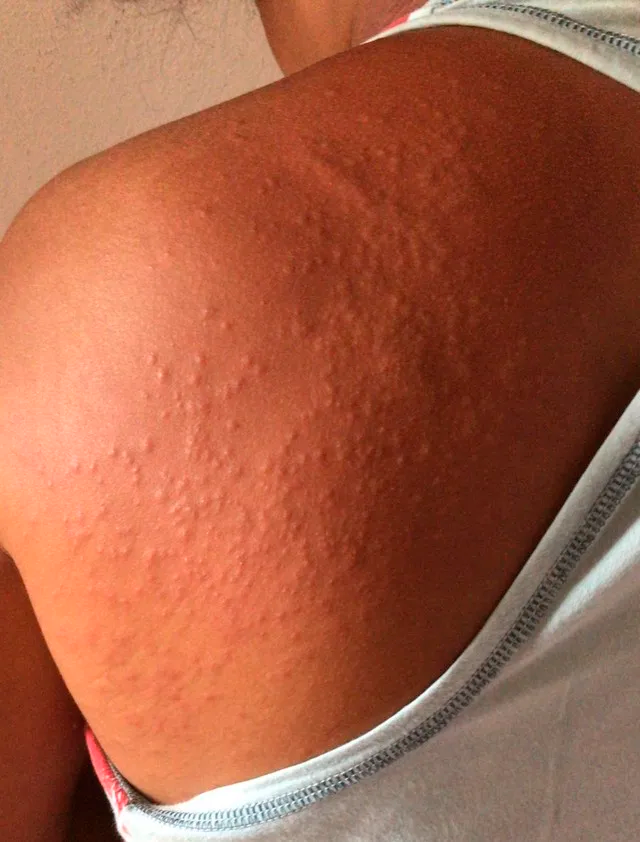 Doença "misteriosa" provoca lesões na pele e coceira em Pernambuco