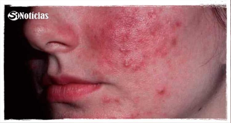 Casos de ‘Coceira misteriosa’ é confirmado em Serra, Triunfo e Floresta