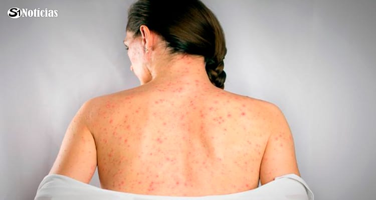 Vacinação cai e traz de volta a rubéola, caxumba, catapora e sarampo