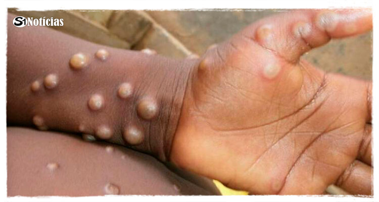 Varíola do macaco: uma doença rara e que geralmente se cura sozinha
