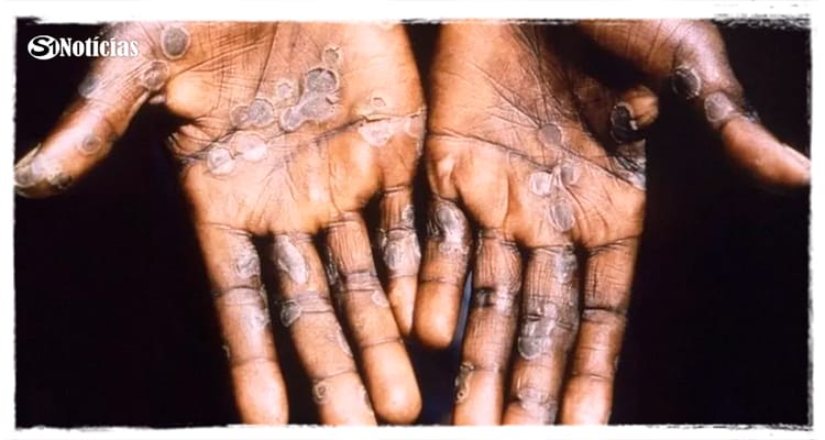 Varíola dos macacos: Anvisa esclarece que não recomendou isolamento