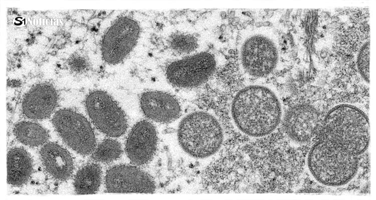 Distrito Federal registra primeiro caso suspeito de varíola dos macacos