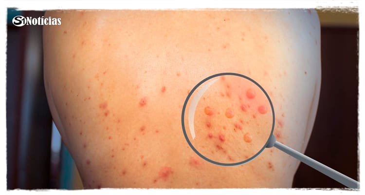 Diretrizes ainda fracas dificultam tratamento da varíola do macaco