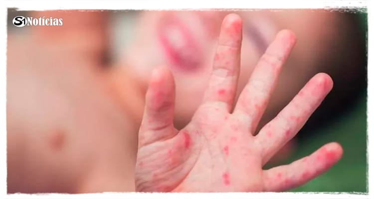 Surto infeccioso de gripe do tomate atinge a Índia; entenda doença