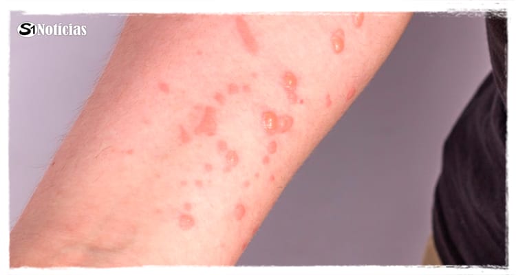 Número de casos de varíola dos macacos quase dobra e sobe para 111 em Pernambuco