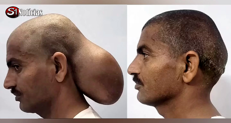 Após 15 anos, homem remove tumor do tamanho de um melão da cabeça