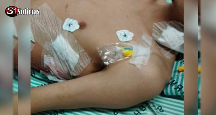 Jovem fuma ''pod'' e perde parte do pulmão; confira