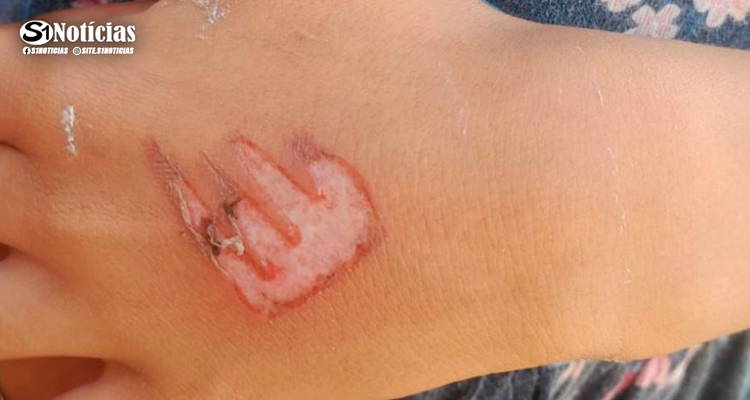 Mãe queima com fósforo a genitália da filha de 7 anos, em Olinda